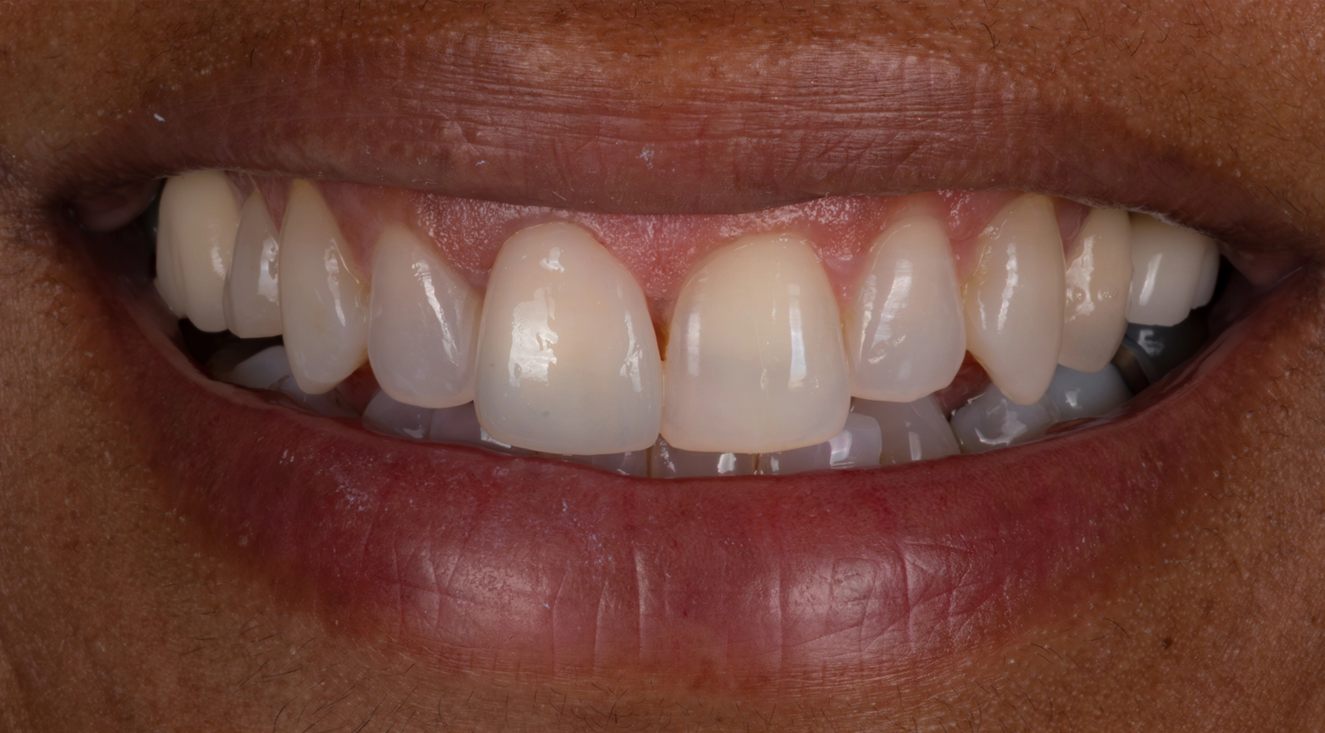 Porcelain veneer smile result D'Amico Dental Care Wayland Watertown MA