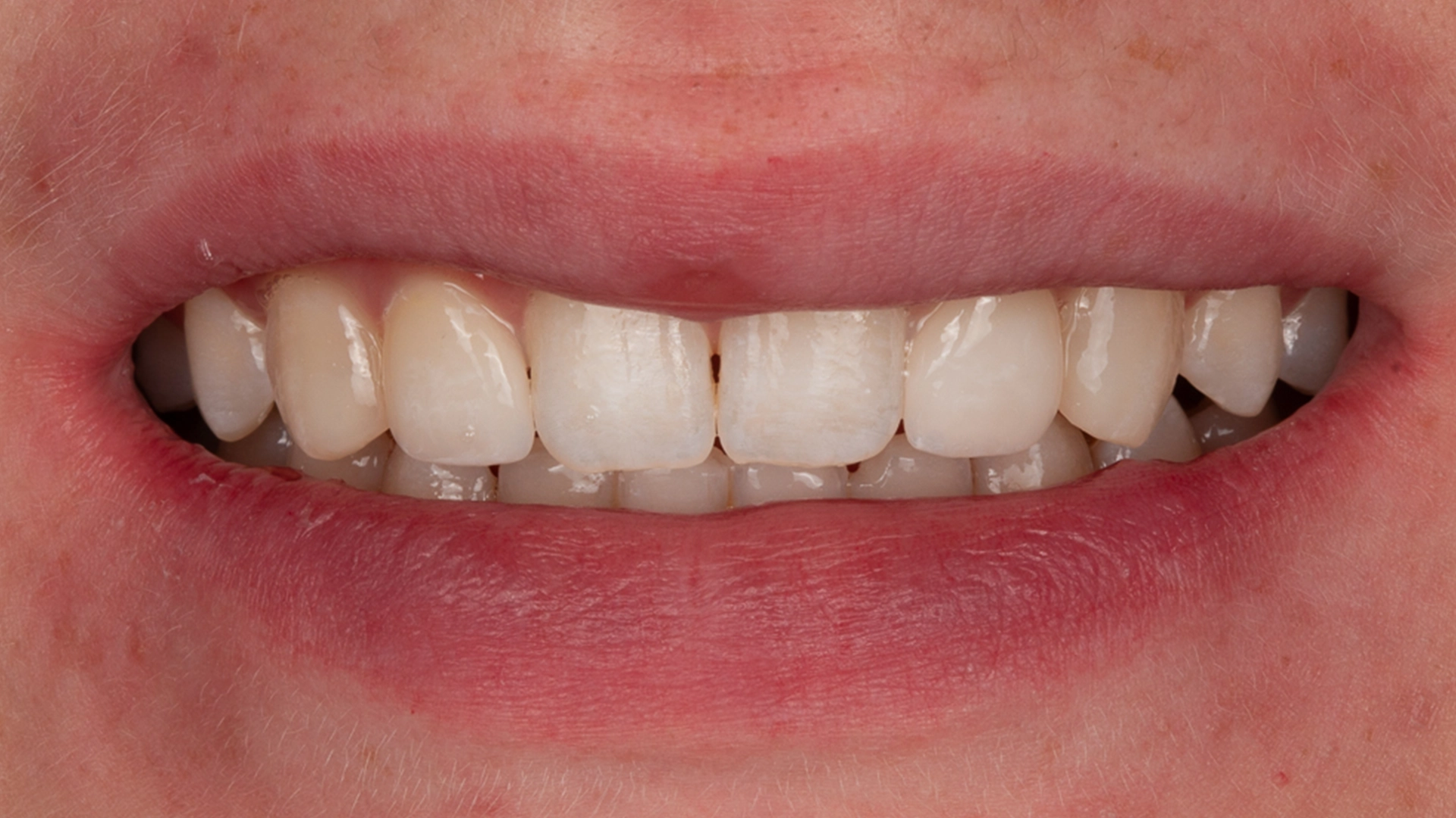 Smile makeover result D'Amico Dental Care Wayland Watertown MA