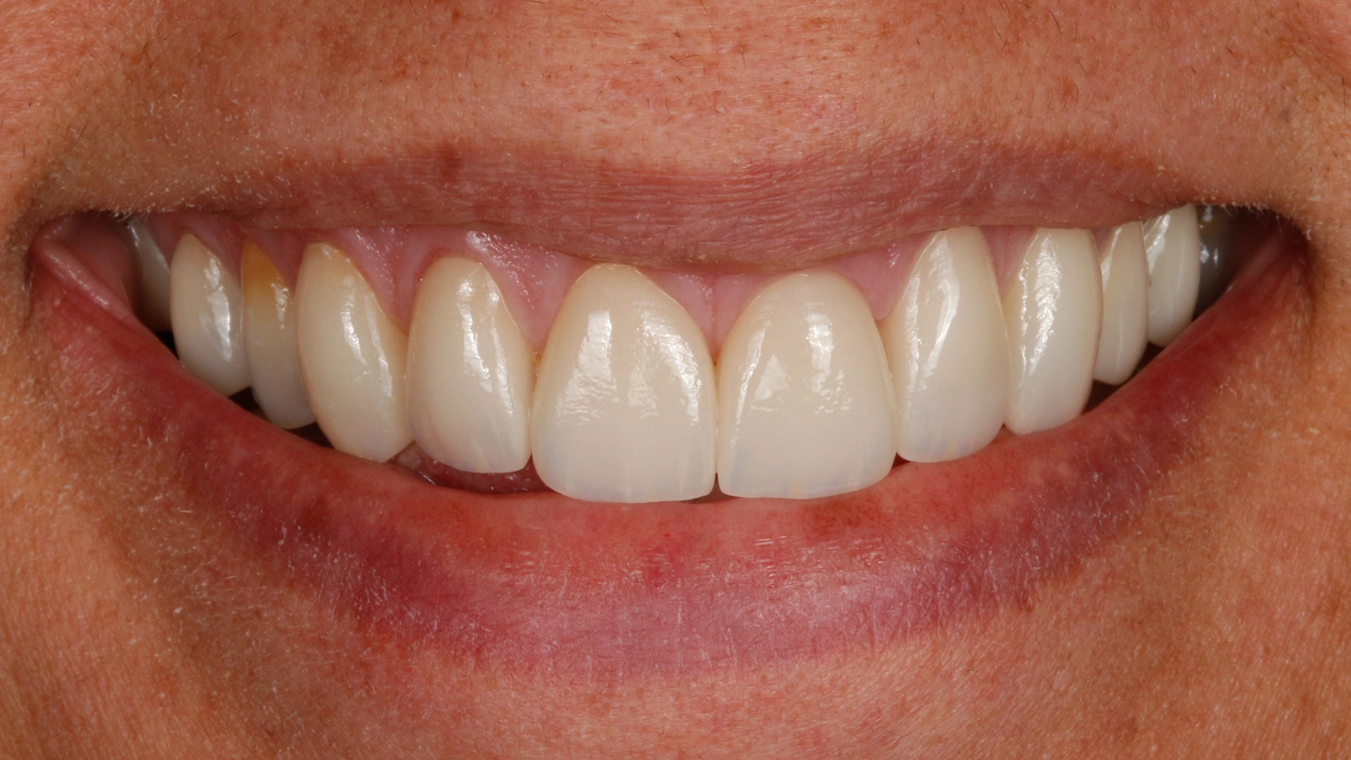 Dental crown smile result D'Amico Dental Care Wayland Watertown MA