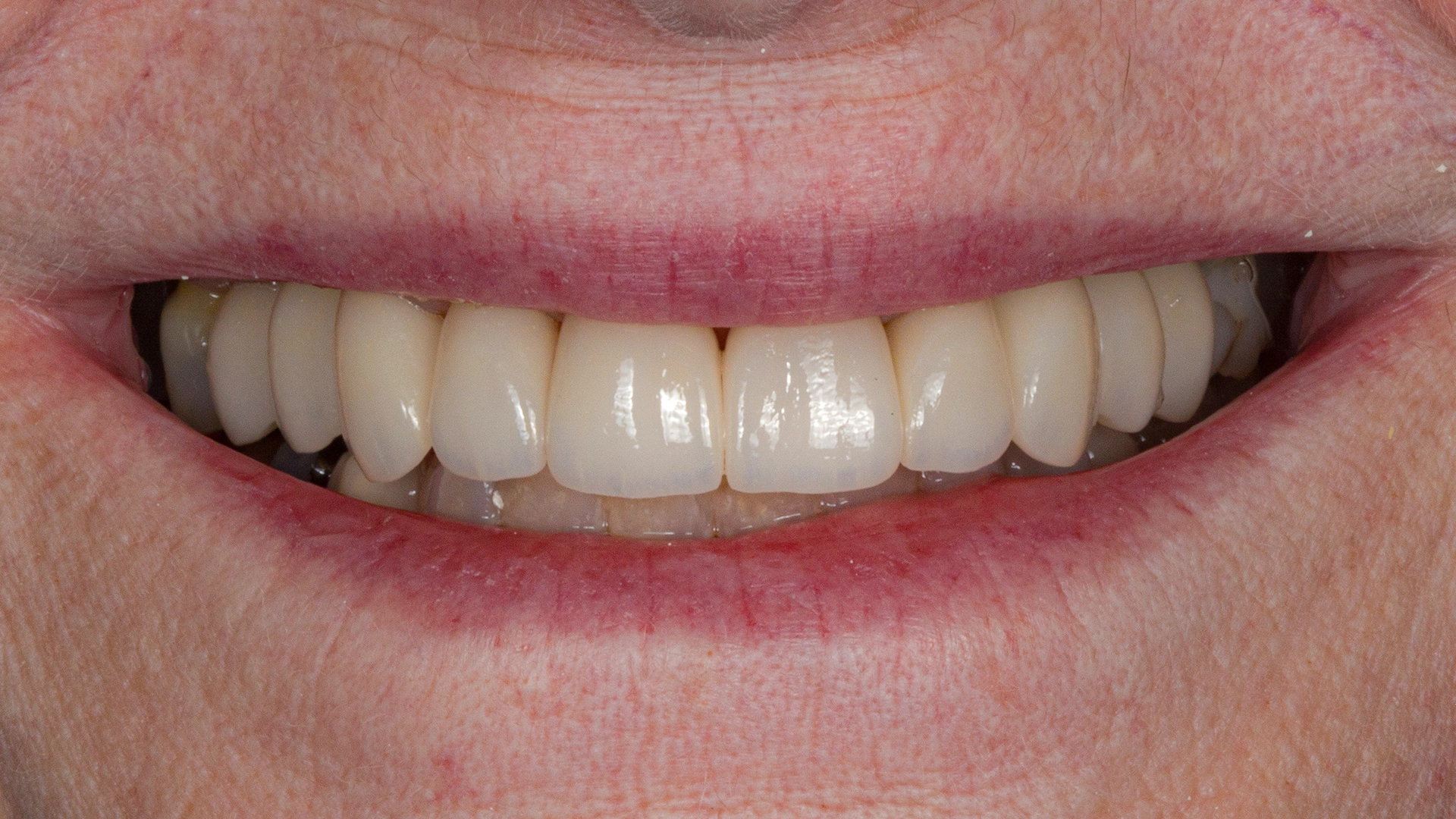 Smile transformation D'Amico Dental Care Wayland Watertown MA