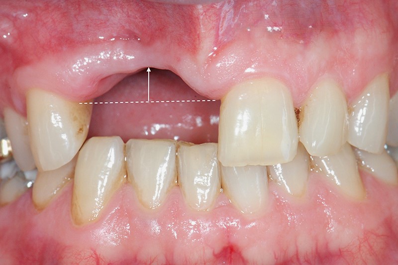 D'Amico Dental Care - What Happens If You Delay Replacing a Missing Tooth - Losing a tooth often feels like a localized issue, especially if it is hidden in the back. Many patients believe that if the gap is out of sight, it can wait.