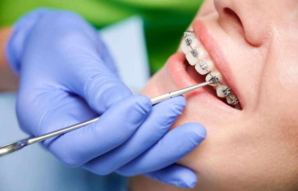 D'Amico Dental Care - Do You Really Need Braces or Aligners? 7 Signs Your Teeth May Need Orthodontic Treatment - Not every crooked tooth requires orthodontic treatment. The decision depends on more than appearance. Crowding, bite changes, food trapping, jaw symptoms, relapse, and difficulty cleaning may indicate that an assessment is worthwhile.