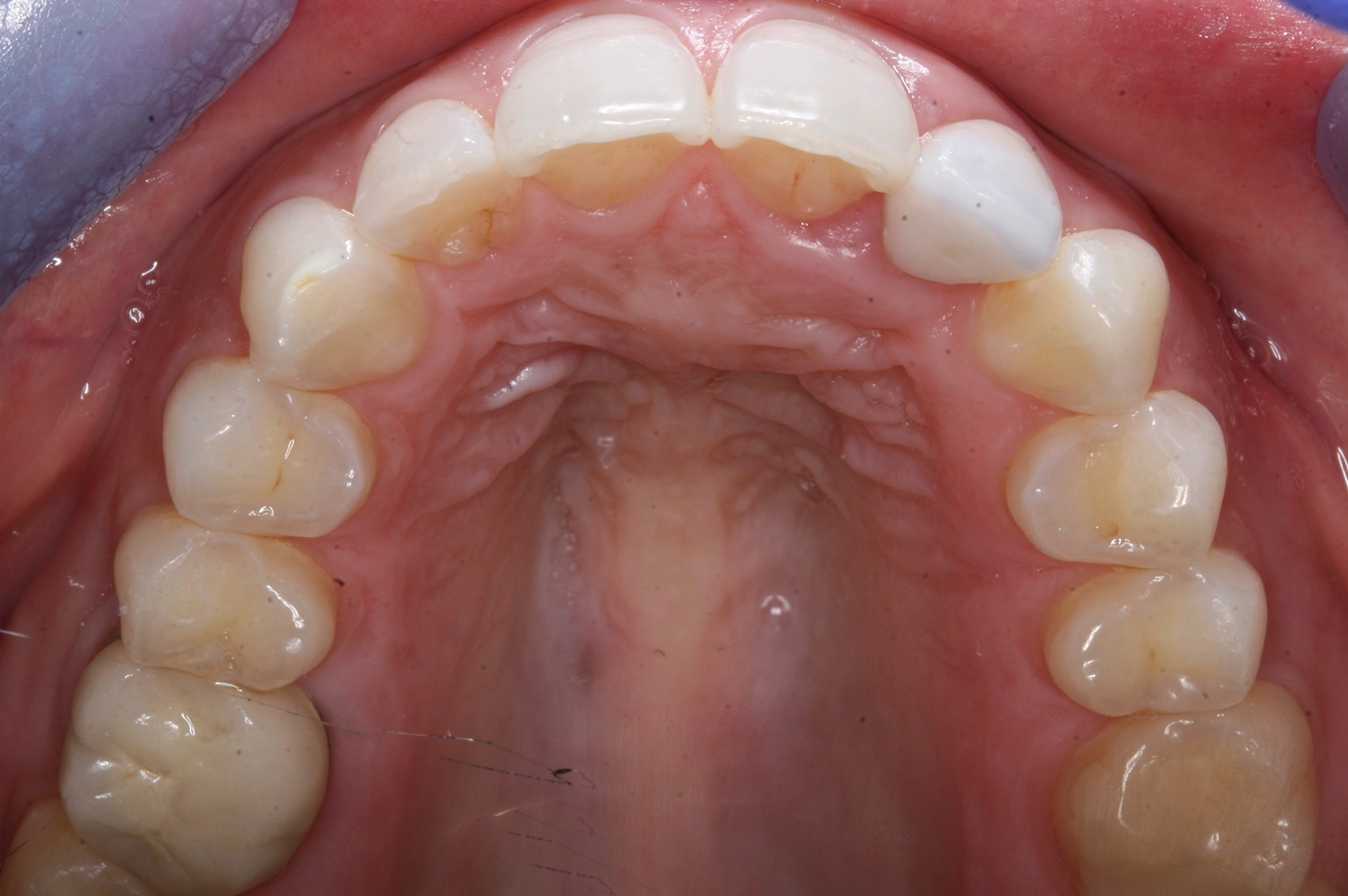 D'Amico Dental Care - Do You Really Need Braces or Aligners? 7 Signs Your Teeth May Need Orthodontic Treatment - Not every crooked tooth requires orthodontic treatment. The decision depends on more than appearance. Crowding, bite changes, food trapping, jaw symptoms, relapse, and difficulty cleaning may indicate that an assessment is worthwhile.