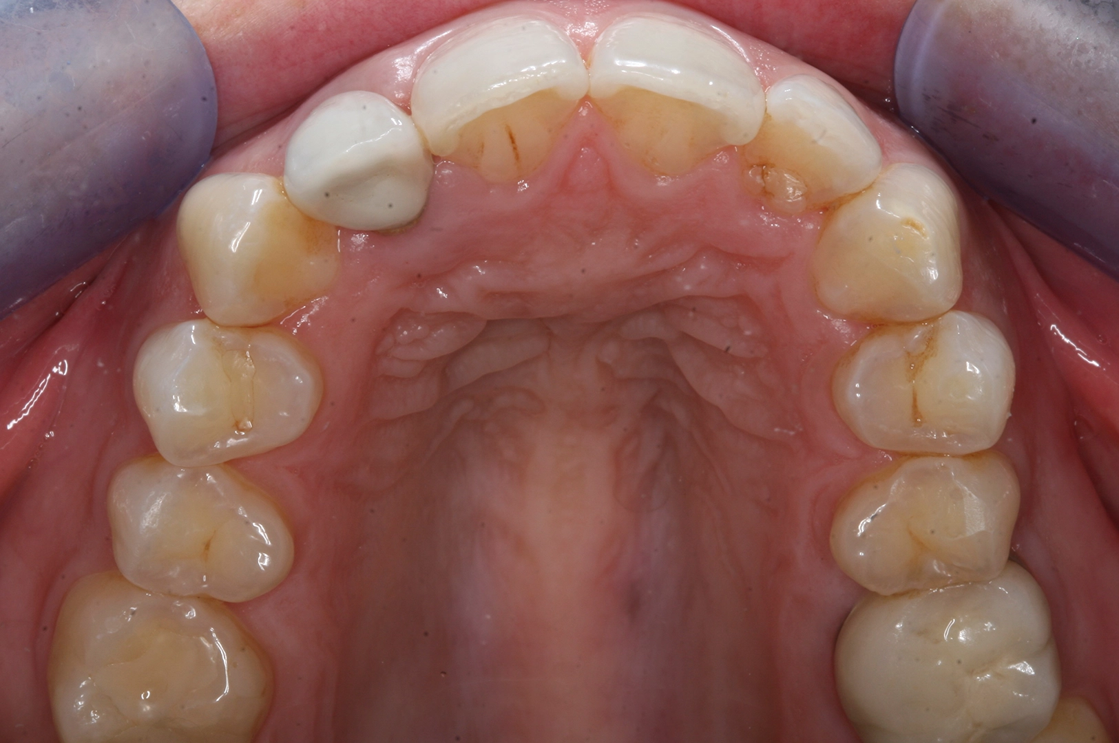 D'Amico Dental Care - Do You Really Need Braces or Aligners? 7 Signs Your Teeth May Need Orthodontic Treatment - Not every crooked tooth requires orthodontic treatment. The decision depends on more than appearance. Crowding, bite changes, food trapping, jaw symptoms, relapse, and difficulty cleaning may indicate that an assessment is worthwhile.